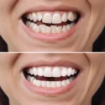 How Composite Bonding Preserves Your Natural Tooth Structure