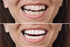 How Composite Bonding Preserves Your Natural Tooth Structure