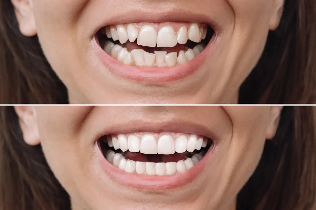 How Composite Bonding Preserves Your Natural Tooth Structure