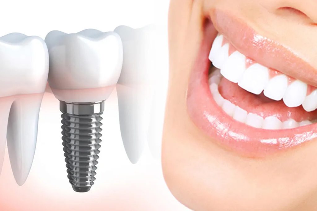How Dental Implants Mimic Natural Tooth Biology for Lasting Results
