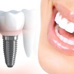 How Dental Implants Mimic Natural Tooth Biology for Lasting Results