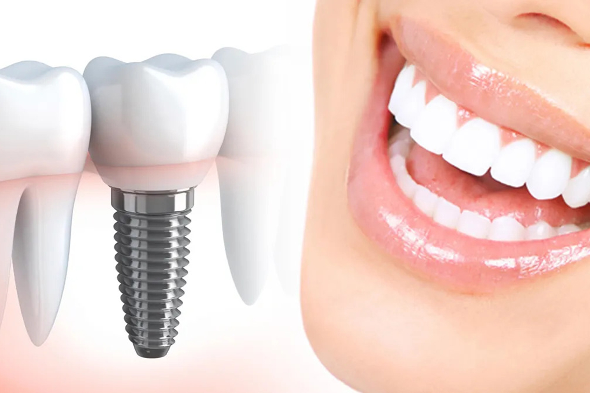 How Dental Implants Mimic Natural Tooth Biology for Lasting Results