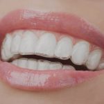 How Invisalign Aligners Improve Speech Clarity During Orthodontic Treatment