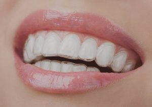 How Invisalign Aligners Improve Speech Clarity During Orthodontic Treatment